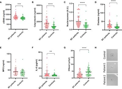 Bladder cancer patients have increased NETosis and impaired DNaseI-mediated NET degradation that can be therapeutically restored in vitro